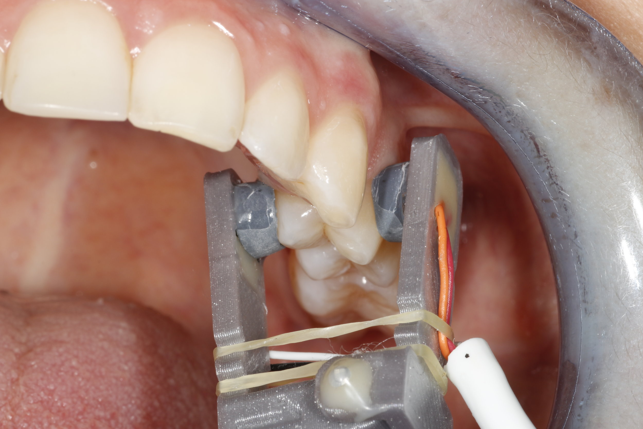 Dental Pulse Oximetry Sensor